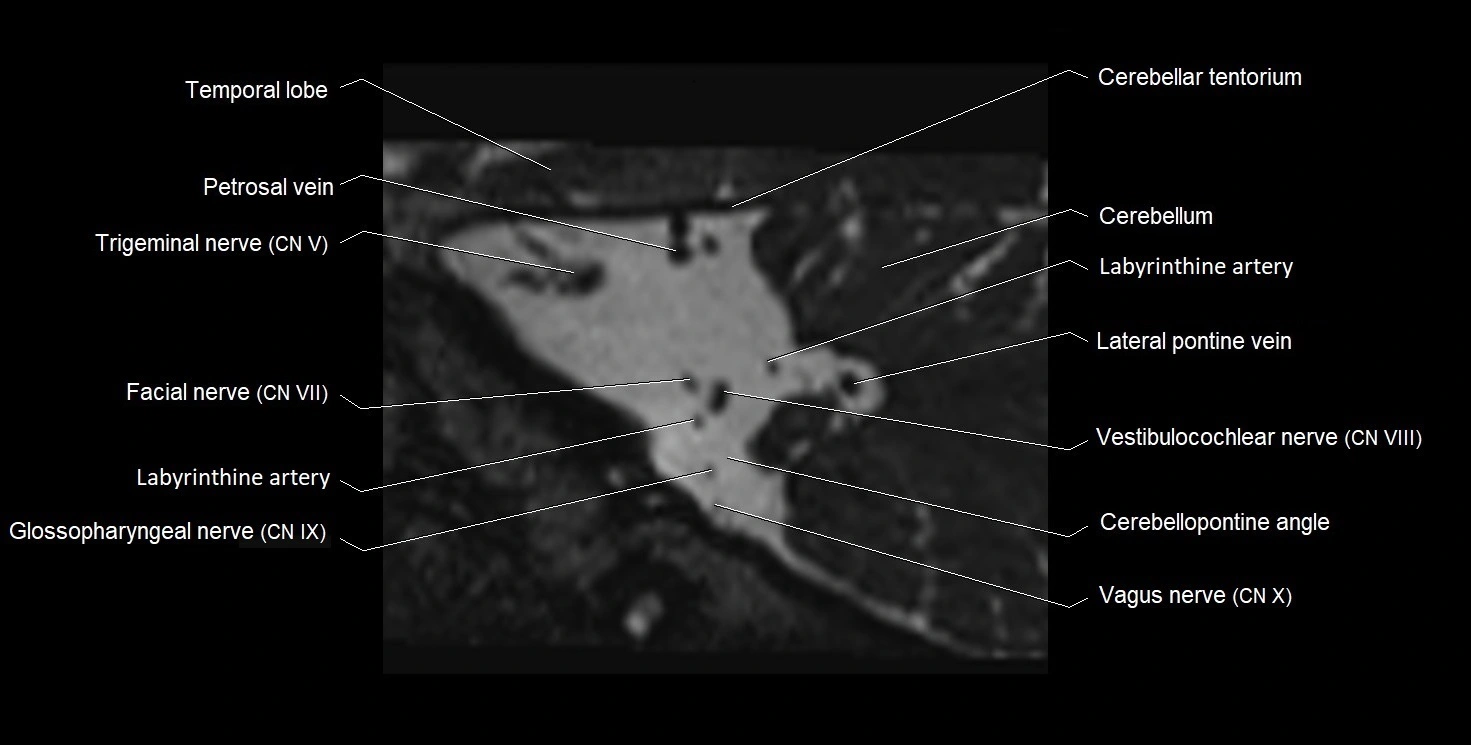 Internal auditory meatus (IAM) 3T sagittal cross sectional anatomy image 33.webp
